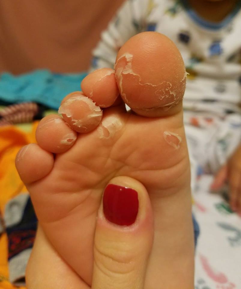 Why Are My Two Year Olds Toes Peeling